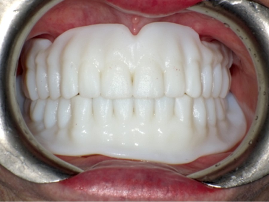 New 
      Dentures Before And After Pictures Mount Vernon TX 75457